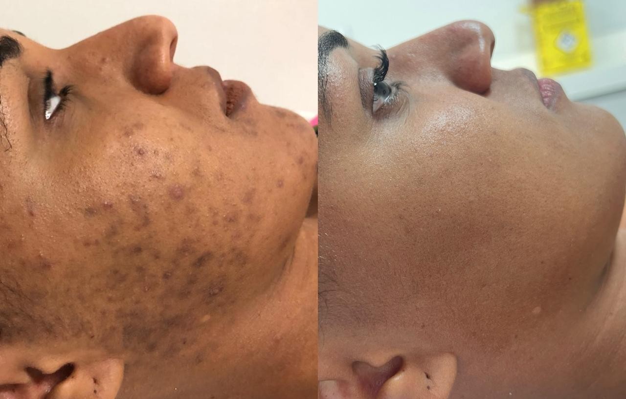 Peeling Químico